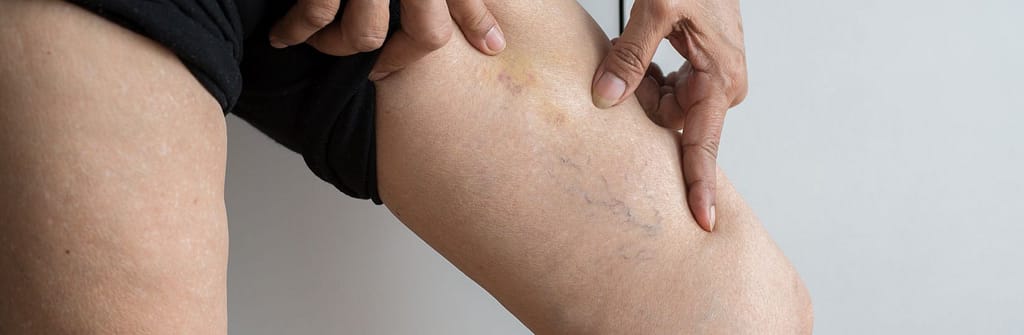 Spider Vein Treatment