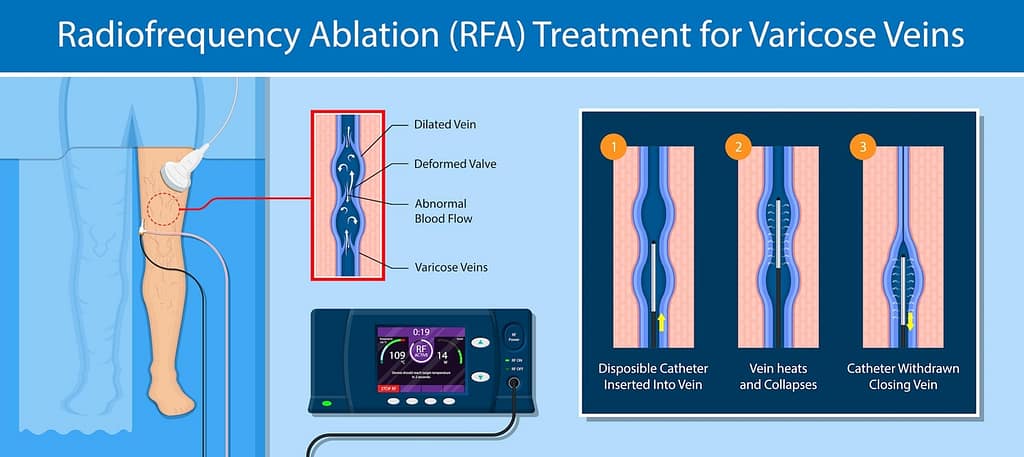Radiofrequency Ablation Treatment
