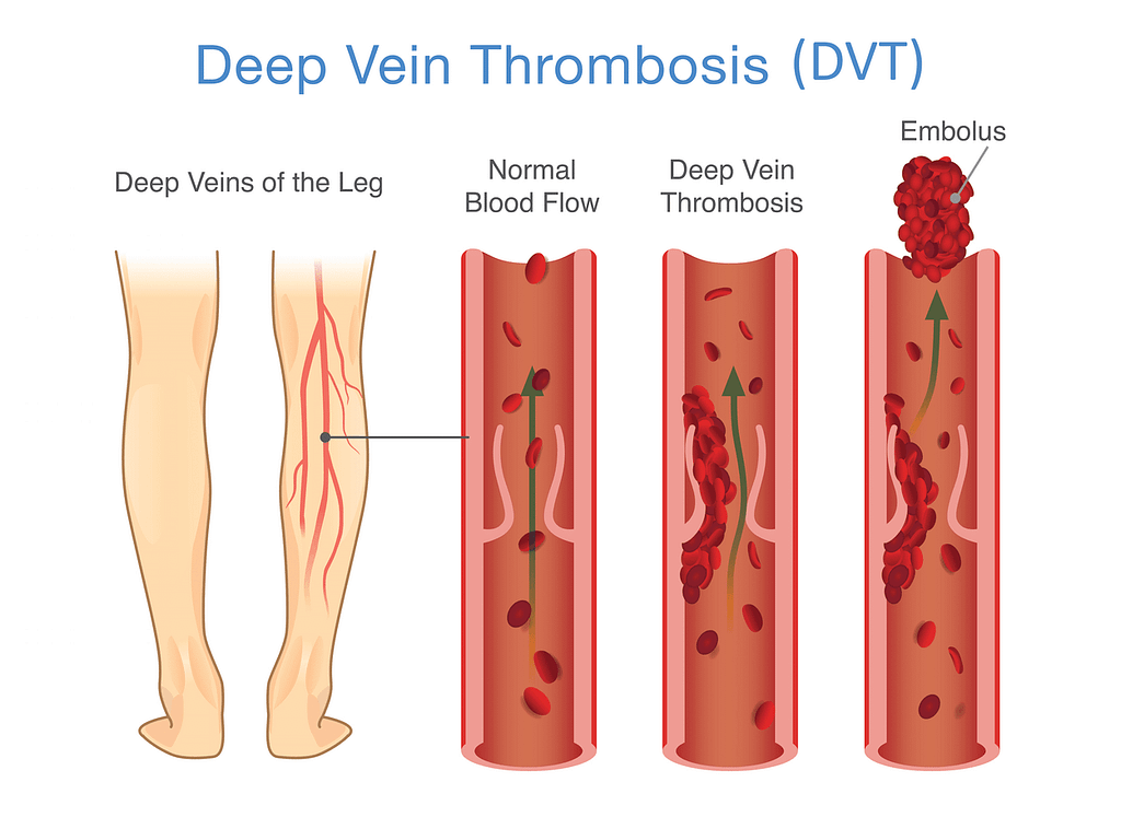 Deep Vein Thrombosis Treatment
